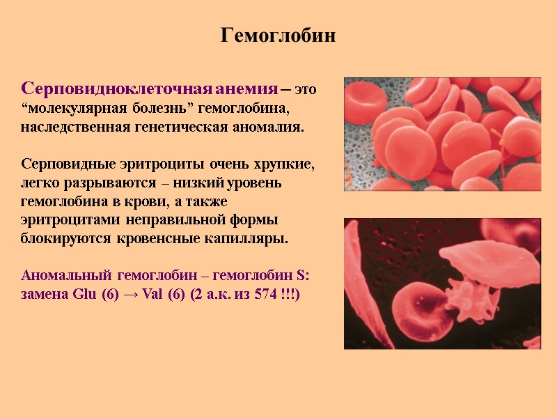 Гемоглобин Серповидноклеточная анемия – это  “молекулярная болезнь” гемоглобина, наследственная генетическая аномалия.  Серповидные
